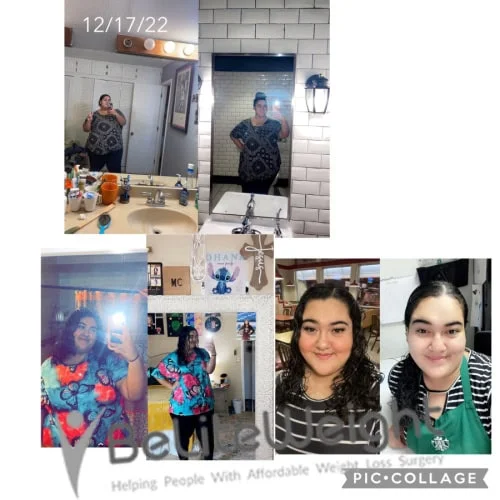 Weight Loss Surgery Gastric Sleeve before and after